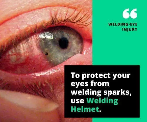 welding eye injury